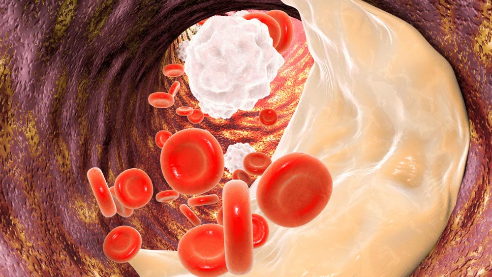 Can High Cholesterol Be Genetic? Can High Cholesterol Be Genetic?